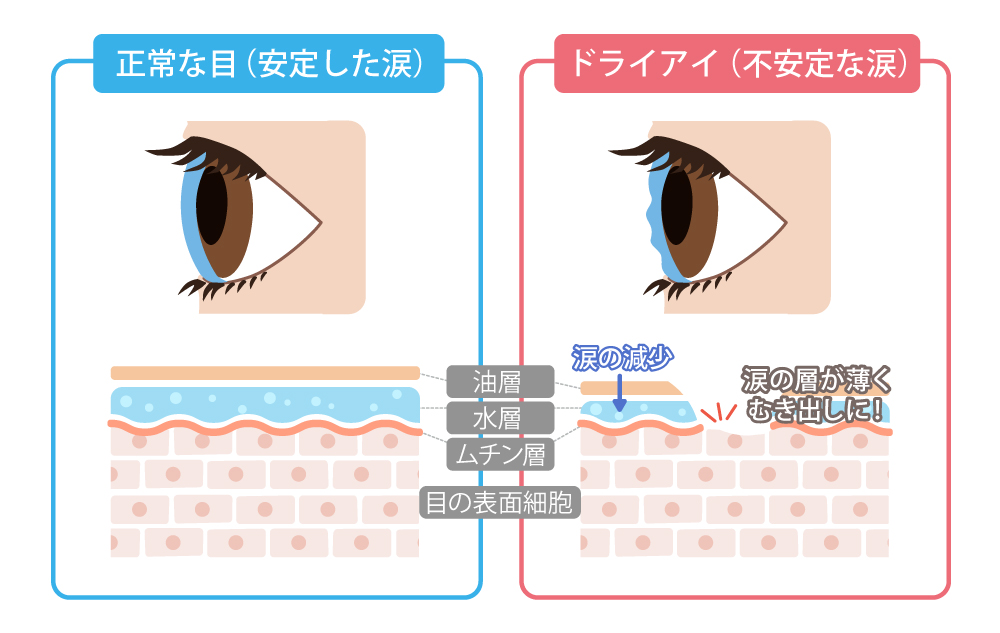 ドライアイの説明図版
